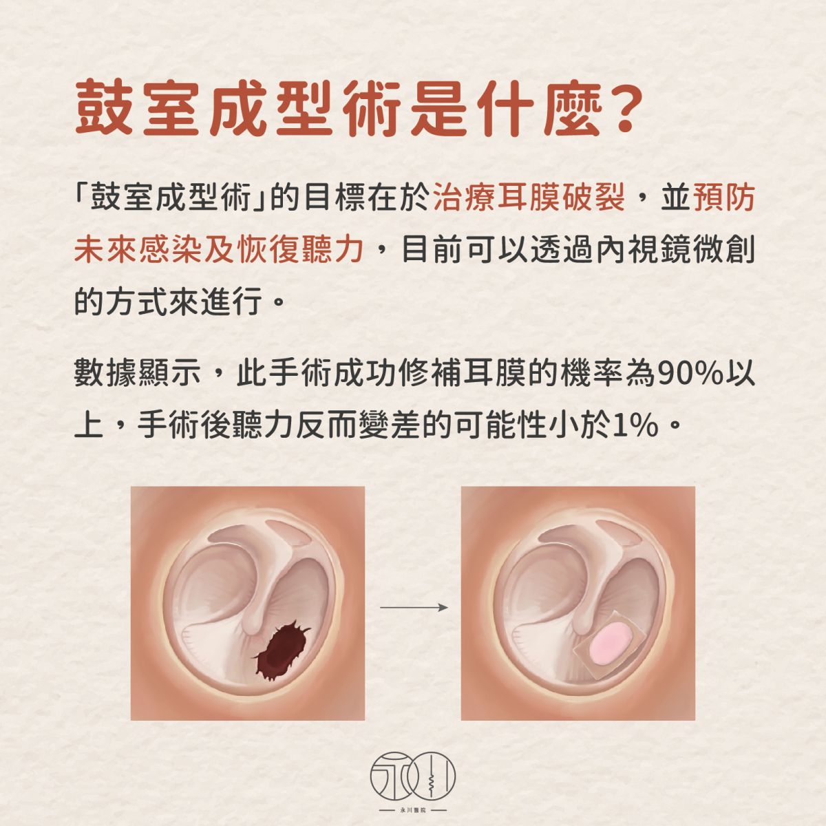 鼓室成型術是什麼