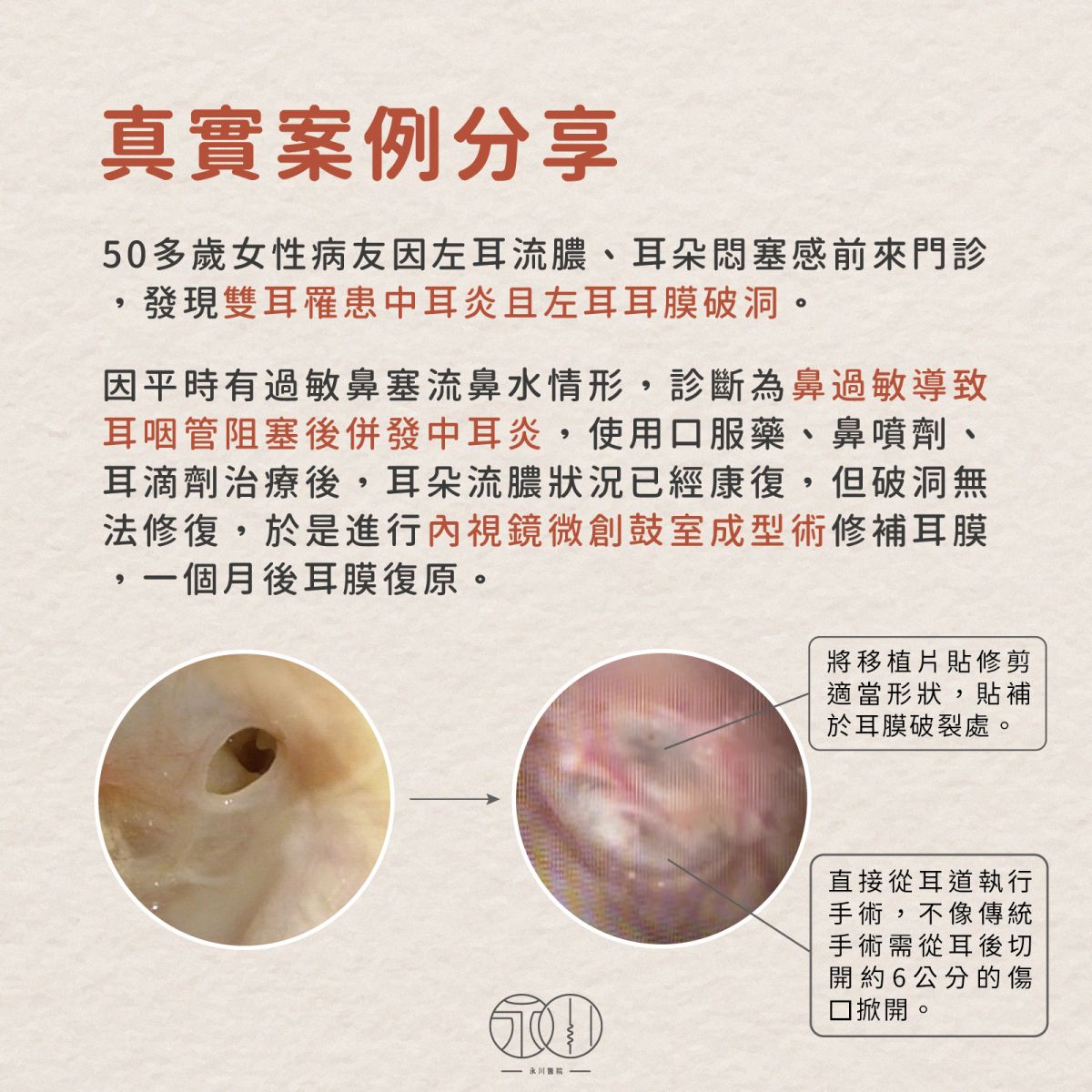 鼓室成型術真實案例分享