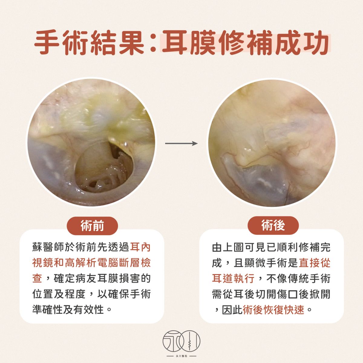 手術耳膜修補成功