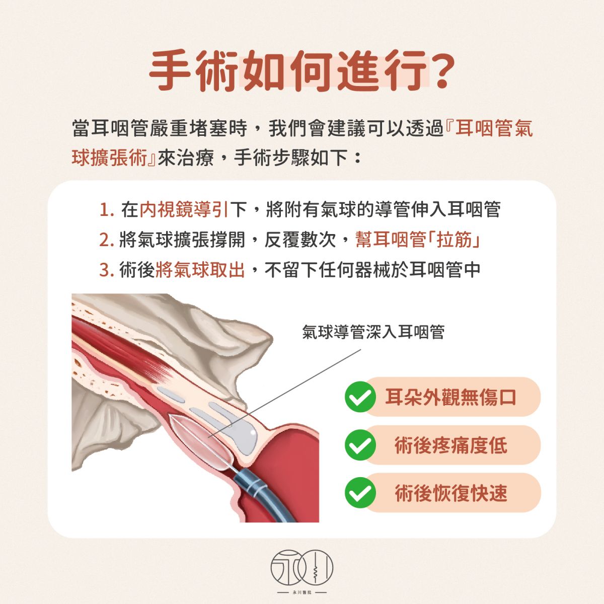 耳咽管氣球擴張術如何進行