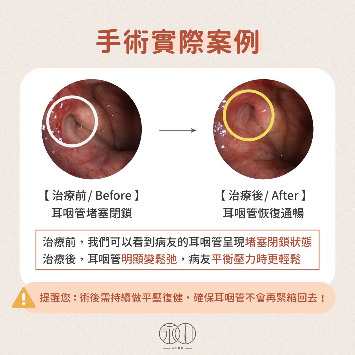耳咽管氣球擴張術實際案例