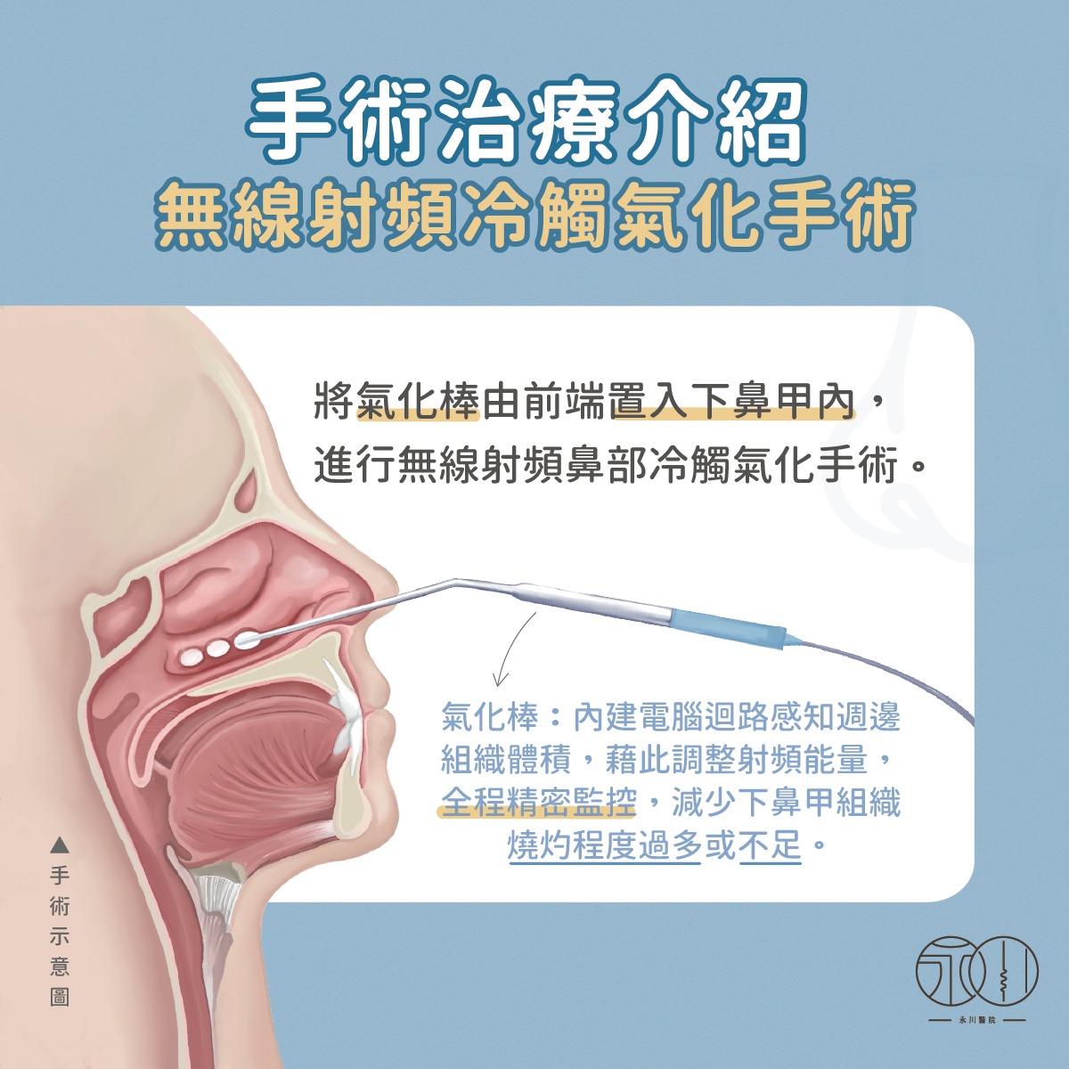 手術治療介紹：無線射頻冷觸氣化手術