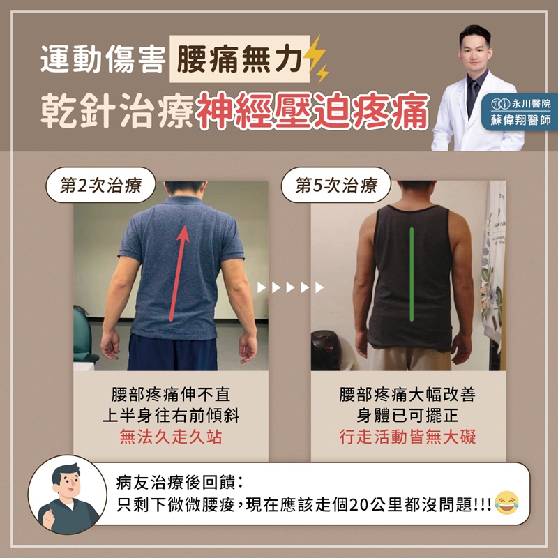 【案例】乾針治療X腰部神經壓迫