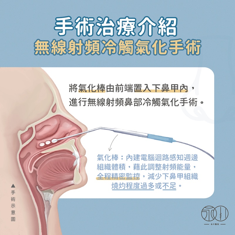 無線射頻冷觸氣化手術介紹